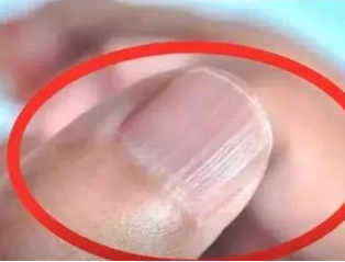 幸福宝app在线观看厂家分析手指甲有竖纹的根本原因 幸福宝app在线观看厂家分析手指甲有竖纹的根本原因